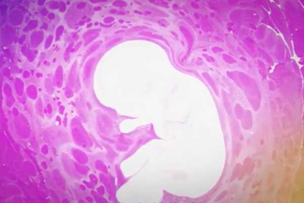 哪里有供卵试管生子的，宫颈妊娠是宫外孕吗